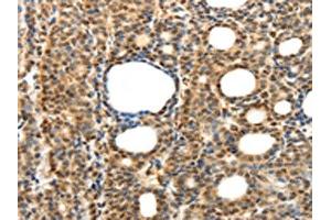 The image on the left is immunohistochemistry of paraffin-embedded Human thyroid cancer tissue using ABIN7131276(SYT7 Antibody) at dilution 1/15, on the right is treated with fusion protein.