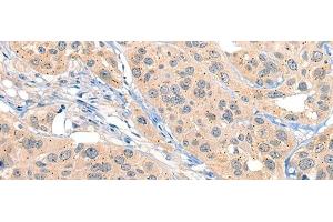 Immunohistochemistry of paraffin-embedded Human esophagus cancer tissue using MIIP Polyclonal Antibody at dilution of 1:45(x200) (MIIP Antikörper)