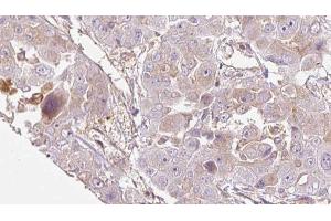 ABIN6272714 at 1/100 staining Human liver cancer tissue by IHC-P. (OR1E1 Antikörper  (C-Term))