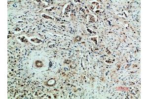 Immunohistochemical analysis of paraffin-embedded human-breast-cancer, antibody was diluted at 1:200 (VEGFR2/CD309 Antikörper  (AA 1268-1341))