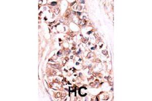 Formalin-fixed and paraffin-embedded human hepatocellular carcinoma tissue reacted with DUSP14 polyclonal antibody  , which was peroxidase-conjugated to the secondary antibody, followed by AEC staining. (DUSP14 Antikörper  (N-Term))