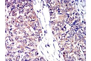 Immunohistochemical analysis of paraffin-embedded bladder cancer tissues using CD53 mouse mAb with DAB staining. (CD53 Antikörper)