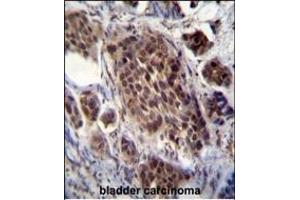 FRAT2 Antibody (C-term) (ABIN655793 and ABIN2845223) immunohistochemistry analysis in formalin fixed and paraffin embedded human bladder carcinoma followed by peroxidase conjugation of the secondary antibody and DAB staining.