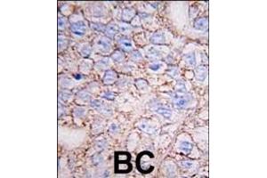 Formalin-fixed and paraffin-embedded human breast carcinoma tissue reacted with ERK8 antibody (N-term) (ABIN391796 and ABIN2841651) , which was peroxidase-conjugated to the secondary antibody, followed by DAB staining. (MAPK15 Antikörper  (N-Term))