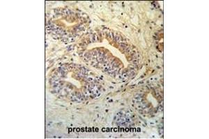 CWC15 Antibody (Center) (ABIN651004 and ABIN2840035) IHC analysis in formalin fixed and paraffin embedded prostate carcinoma followed by peroxidase conjugation of the secondary antibody and DAB staining. (CWC15 Antikörper  (AA 123-152))