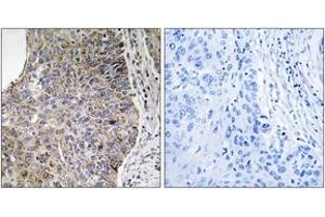 Immunohistochemistry analysis of paraffin-embedded human lung carcinoma tissue, using NEK7 Antibody. (NEK7 Antikörper  (AA 101-150))