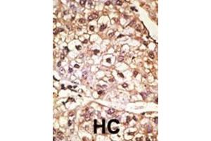 Formalin-fixed and paraffin-embedded human cancer tissue reacted with the primary antibody, which was peroxidase-conjugated to the secondary antibody, followed by AEC staining. (SNCA Antikörper  (C-Term))