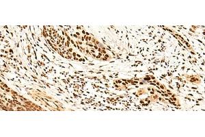 Immunohistochemistry of paraffin-embedded Human esophagus cancer tissue using METTL1 Polyclonal Antibody at dilution of 1:50(x200) (METTL1 Antikörper)