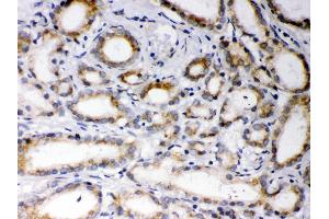 Anti- EBAG9 Picoband antibody,IHC(P) IHC(P): Human Prostatic Cancer Tissue (RCAS1 Antikörper  (AA 31-213))