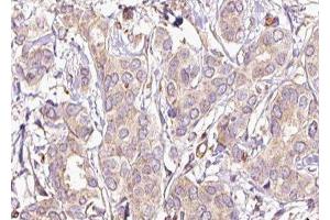 ABIN6277438 at 1/100 staining Human breast cancer tissue by IHC-P. (TPM2 Antikörper  (C-Term))