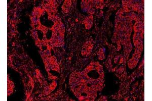 IF analysis of MYD88 using anti-MYD88 antibody (ABIN3043887) MYD88 was detected in paraffin-embedded section of human colon cancar tissues.