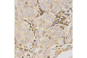 Immunohistochemistry of paraffin-embedded human liver cancer using KLK5 antibody (ABIN5971539) at dilution of 1/200 (40x lens). (Kallikrein 5 Antikörper)