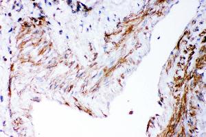 Anti- DHFR Picoband antibody,IHC(P) IHC(P): Human Lung Cancer Tissue