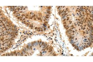 Immunohistochemistry of paraffin-embedded Human colon cancer tissue using SSB Polyclonal Antibody at dilution 1:50 (SSB Antikörper)