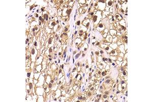 Immunohistochemistry of paraffin-embedded human kidney cancer using TCEB3 antibody. (TCEB3 Antikörper)