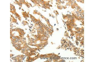 Immunohistochemistry of Human gastric cancer using RARRES1 Polyclonal Antibody at dilution of 1:60 (RARRES1 Antikörper)