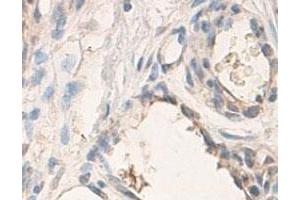 Immunohistochemical staining of formalin-fixed paraffin-embedded human skin tissue with ADAMTS3 polyclonal antibody  at 1 : 100 dilution.