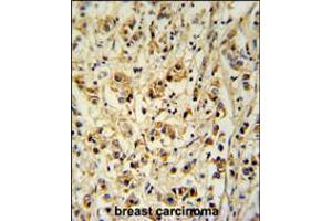 SMAGP Antibody immunohistochemistry analysis in formalin fixed and paraffin embedded human breast carcinoma followed by peroxidase conjugation of the secondary antibody and DAB staining. (SMAGP Antikörper  (AA 46-75))