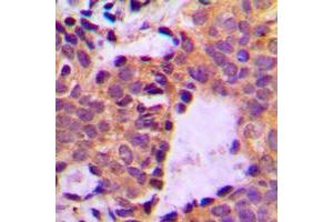 Immunohistochemical analysis of Cortactin (pY466) staining in human breast cancer formalin fixed paraffin embedded tissue section. (Cortactin Antikörper  (C-Term, pTyr466))