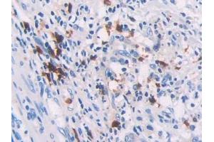 DAB staining on IHC-P; Samples: Human Colorectal cancer Tissue (RHOQ Antikörper  (AA 1-202))