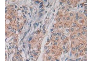 DAB staining on IHC-P; Samples: Human Breast cancer Tissue)