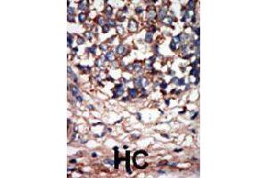 Formalin-fixed and paraffin-embedded human hepatocellular carcinoma tissue reacted with NEK9 polyclonal antibody  , which was peroxidase-conjugated to the secondary antibody, followed by AEC staining. (NEK9 Antikörper  (C-Term))
