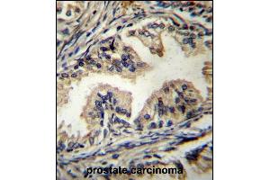 STBP Antibody (C-term) (ABIN656627 and ABIN2845873) immunohistochemistry analysis in formalin fixed and paraffin embedded human prostate carcinoma followed by peroxidase conjugation of the secondary antibody and DAB staining.