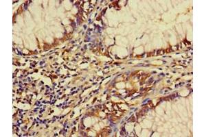 Immunohistochemistry of paraffin-embedded human colon cancer using ABIN7152491 at dilution of 1:100 (FBXW12 Antikörper  (AA 1-250))