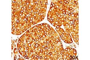 IHC staining of melanoma tissue (20X) with Tyrosinase antibody (T311).
