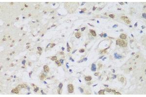 Immunohistochemistry of paraffin-embedded Human gastric cancer using DHX38 Polyclonal Antibody at dilution of 1:150 (40x lens). (DHX38 Antikörper)