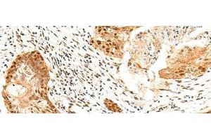 Immunohistochemistry of paraffin-embedded Human esophagus cancer tissue using SETMAR Polyclonal Antibody at dilution of 1:60(x200)