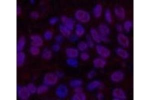 Immunofluorescence analysis of Human lung cancer tissue using Transferrin Monoclonal Antibody at dilution of 1:200. (Transferrin Antikörper)