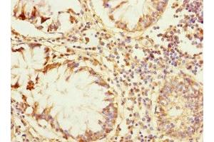 Immunohistochemistry of paraffin-embedded human colon cancer using ABIN7176726 at dilution of 1:100 (ZP2 Antikörper  (AA 651-745))