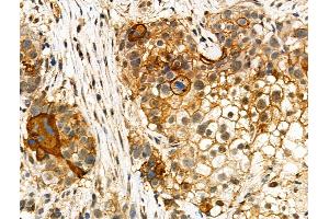 ABIN7093100 and ABIN7097254 at 1/100 staining Human ovarian cancer by IHC-P. (MLKL Antikörper  (pSer347))