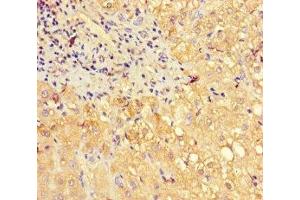 Immunohistochemistry of paraffin-embedded human liver cancer using ABIN7160703 at dilution of 1:100 (PGLYRP2 Antikörper  (AA 22-576))
