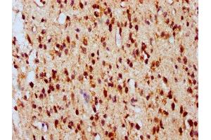 IHC image of ABIN7145109 diluted at 1:700 and staining in paraffin-embedded human glioma performed on a Leica BondTM system. (ATG16L2 Antikörper  (AA 262-348))