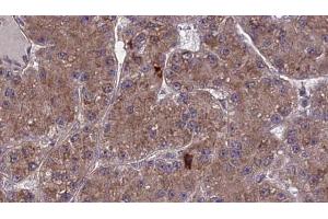 ABIN6273976 at 1/100 staining Human liver cancer tissue by IHC-P. (OR2A2 Antikörper  (Internal Region))