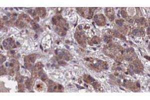 ABIN6273860 at 1/100 staining Human liver cancer tissue by IHC-P. (GPR20 Antikörper  (C-Term))