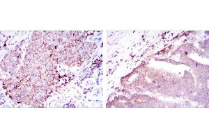 Immunohistochemical analysis of paraffin-embedded kidney cancer tissues (left) and stomach cancer tissues (right) using BMPR2 mouse mAb with DAB staining. (BMPR2 Antikörper)