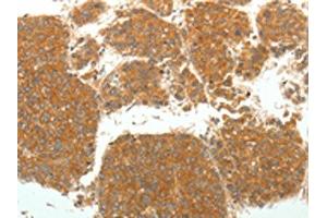 The image on the left is immunohistochemistry of paraffin-embedded Human liver cancer tissue using ABIN7131067(SIRT4 Antibody) at dilution 1/25. (SIRT4 Antikörper)