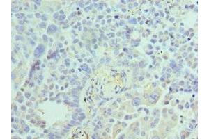 Immunohistochemistry of paraffin-embedded human lung cancer using ABIN7143847 at dilution of 1:100 (ACTR1A Antikörper  (AA 187-376))
