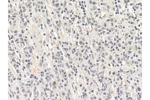 IKK-beta Mouse Monoclonal Antibody at 1/100 staining human gastric cancer by IHC-P.
