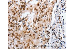 Immunohistochemistry of Human cervical cancer using MUTYH Polyclonal Antibody at dilution of 1:25