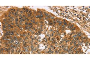 Immunohistochemistry of paraffin-embedded Human esophagus cancer using TNFSF15 Polyclonal Antibody at dilution of 1:40 (TNFSF15 Antikörper)
