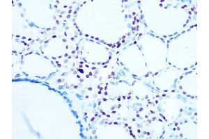 Immunohistochemistry of paraffin-embedded human thyroid cancer using Histone H1. (Histone H1 Antikörper)