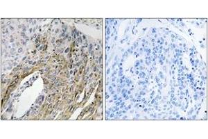 Immunohistochemistry analysis of paraffin-embedded human lung carcinoma tissue, using LONP2 Antibody. (LONP2 Antikörper  (AA 780-829))