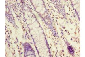 Immunohistochemistry of paraffin-embedded human colon cancer using ABIN7162093 at dilution of 1:100