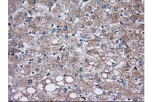 Immunohistochemical staining of paraffin-embedded Carcinoma of Human prostate tissue using anti-TBXAS1 mouse monoclonal antibody. (TBXAS1 Antikörper)