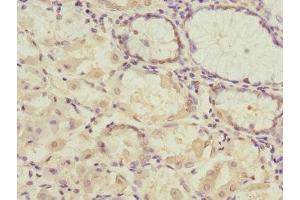 Immunohistochemistry of paraffin-embedded human gastric cancer using ABIN7166902 at dilution of 1:100 (PDHB Antikörper  (AA 1-300))