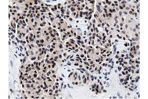 Immunohistochemical staining of paraffin-embedded Carcinoma of Human lung tissue using anti-NT5DC1 mouse monoclonal antibody. (NT5DC1 Antikörper)